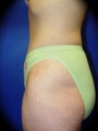 Tummy Tuck