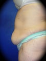 Tummy Tuck