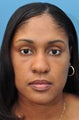 African American Rhinoplasty