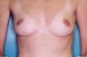 29 Year Old Female Breast Augmentation