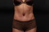 Tummy Tuck