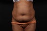Tummy Tuck