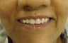 Cosmetic Dental treatment with laminates and crowns: Full Mouth Rehabilitation