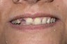 Cosmetic Dental treatment with laminates and crowns: Full Mouth Rehabilitation