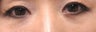 Bilateral Lower Blepharoplasty