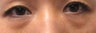 Bilateral Lower Blepharoplasty