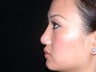 Rhinoplasty