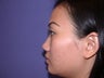 Rhinoplasty
