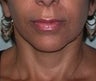 48 year old female patient 