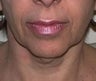 48 year old female patient 
