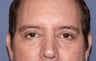 Eyelid Surgery