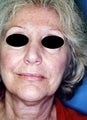 60 year old female patient 