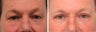 Blepharoplasty Before & 2 Month After - male
