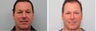 Blepharoplasty Before & 2 Month After - male