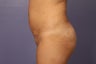 Butt Augmentation
