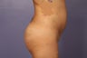 Butt Augmentation