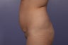 Butt Augmentation