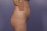 Butt Augmentation
