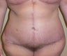 46 year old woman has Belt Lipectomy
