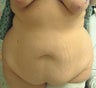 46 year old woman has Belt Lipectomy