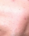 Accutane