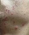 Accutane
