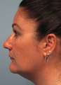 Exilis