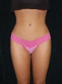 Liposuction Case