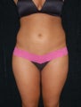 Liposuction Case