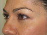 42 year old female with eyelid bags