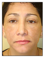 Laser Resurfacing