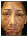 Laser Resurfacing