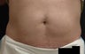Coolsculpting