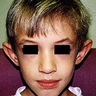 Ear Surgery
