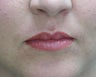 Lip Augmentation with fat transfer