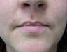 Lip Augmentation with fat transfer