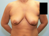 Breast Augmentation
