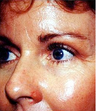 Cheek Augmentation