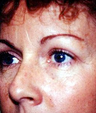 Cheek Augmentation