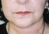 53 year old female patient 