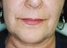 53 year old female patient 