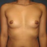 Bilateral breast augmentation with 330cc High Profile Saline implants filled to 400cc.