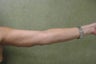 Arm Lift