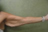 Arm Lift
