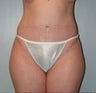 35 year old female underwent a mommy makeover 