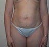 35 year old female underwent a mommy makeover 