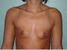 Breast Augmentation