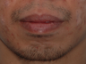 Lower Lip Reduction 