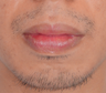 Lower Lip Reduction 