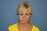 Face Lift and Blepharoplasty